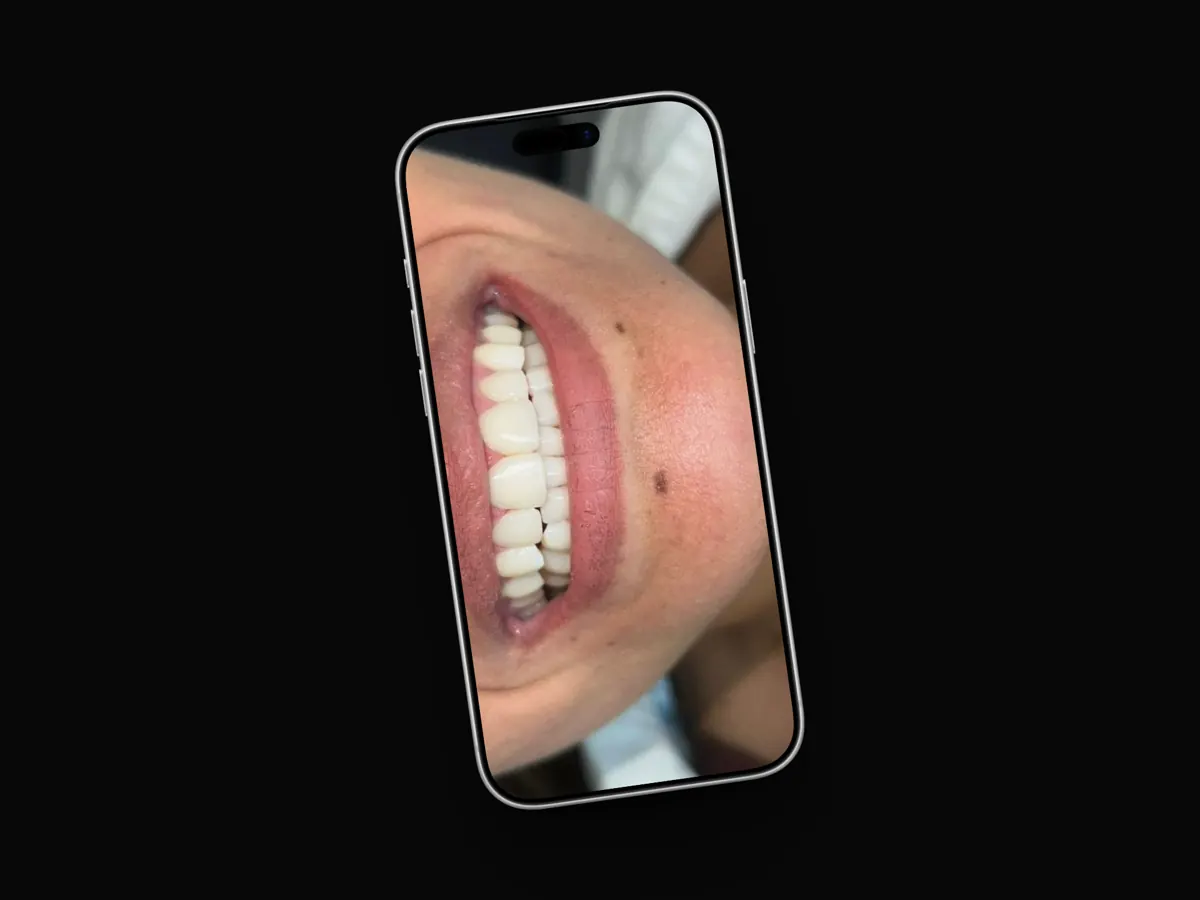 Sonrisa con carillas vista en la pantalla de un celular