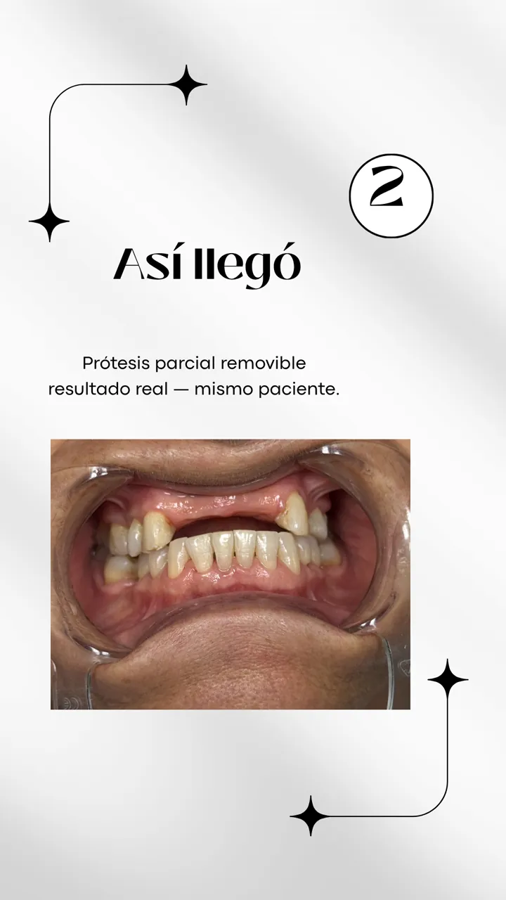 Lámina 3 de 6: Así llegó. Prótesis parcial removible, resultado real, mismo paciente.