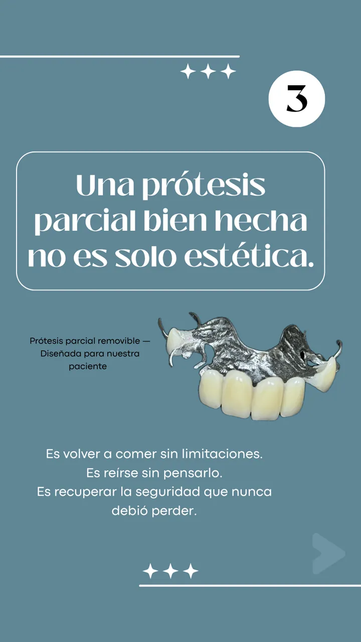 Lámina 4 de 6: Una prótesis parcial bien hecha no es solo estética.