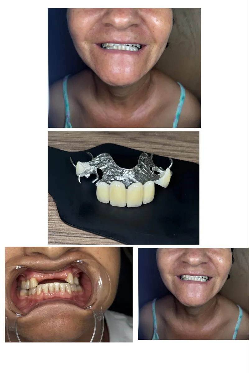 Collage de las 4 fotos crudas que envió la clínica: sonrisa con la prótesis, la prótesis sobre la mesa y la boca antes del tratamiento