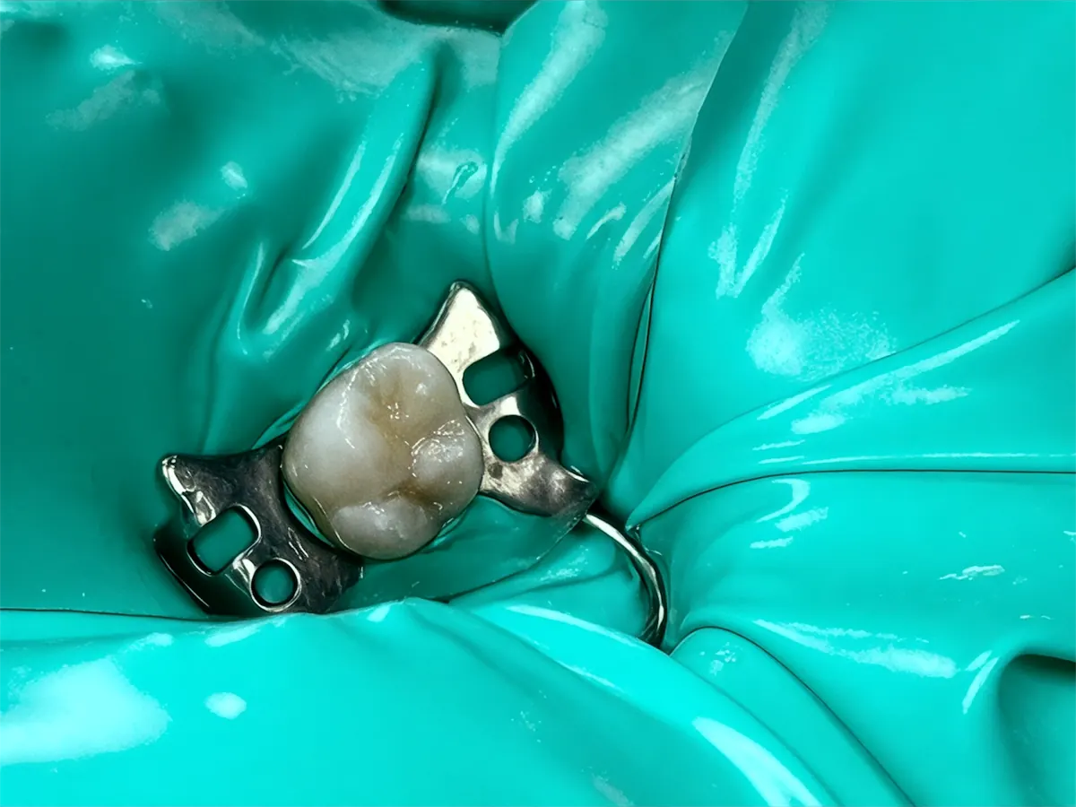 Foto clínica: muela aislada con dique de goma verde