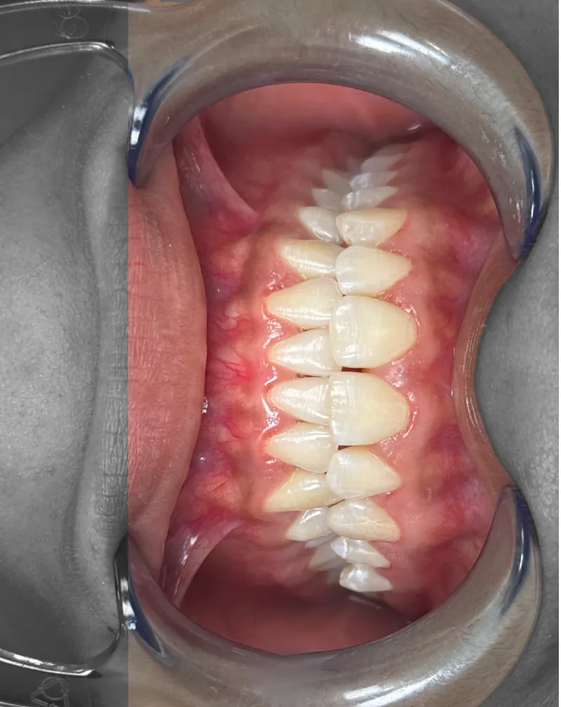 Foto intraoral editada: una mitad en blanco y negro y la otra en color